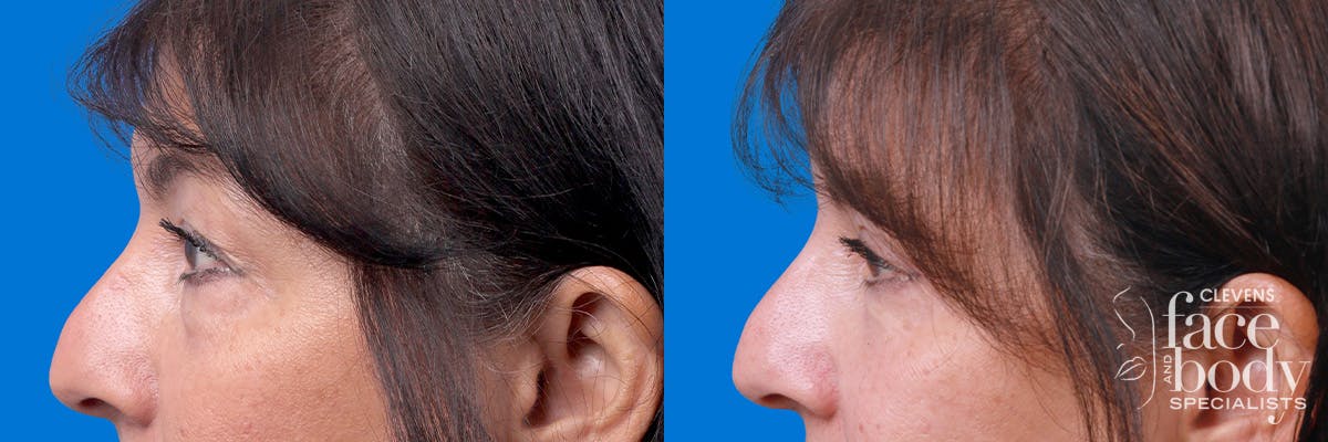 Eyelid Surgery Before & After Gallery - Patient 114068 - Image 5