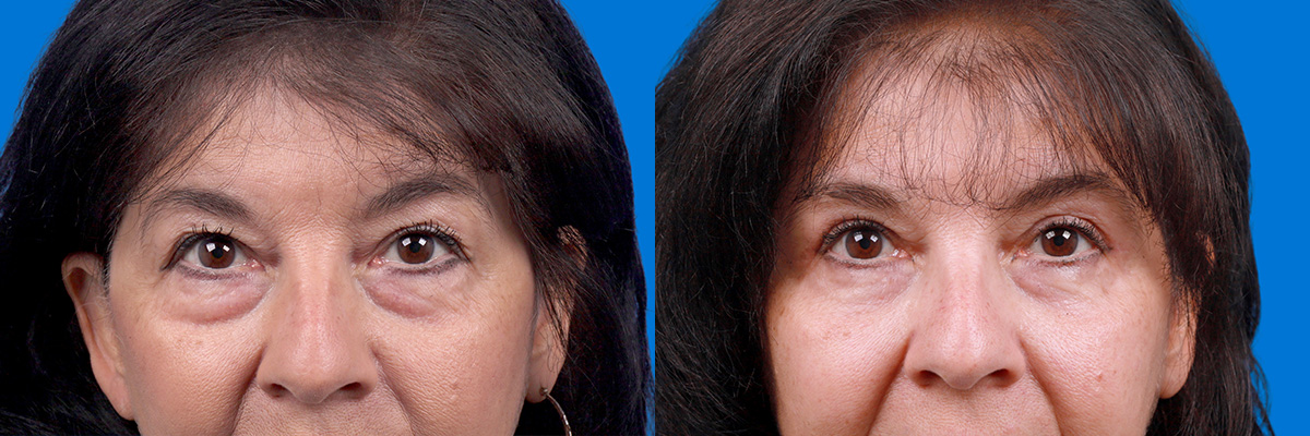 Eyelid Surgery Before & After Gallery - Patient 114068 - Image 1