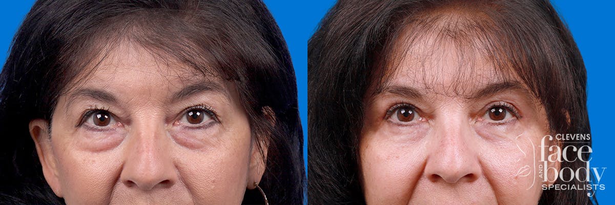 Eyelid Surgery Before & After Gallery - Patient 114068 - Image 1