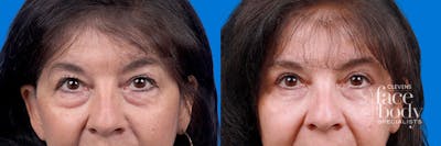 Eyelid Surgery Before & After Gallery - Patient 114068 - Image 1