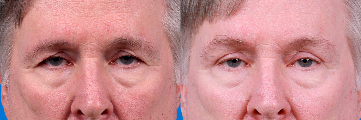 Eyelid Surgery Before & After Gallery - Patient 278662 - Image 1