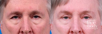 Eyelid Surgery Before & After Gallery - Patient 278662 - Image 1