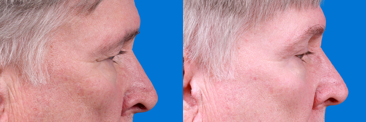 Eyelid Surgery Before & After Gallery - Patient 278662 - Image 3