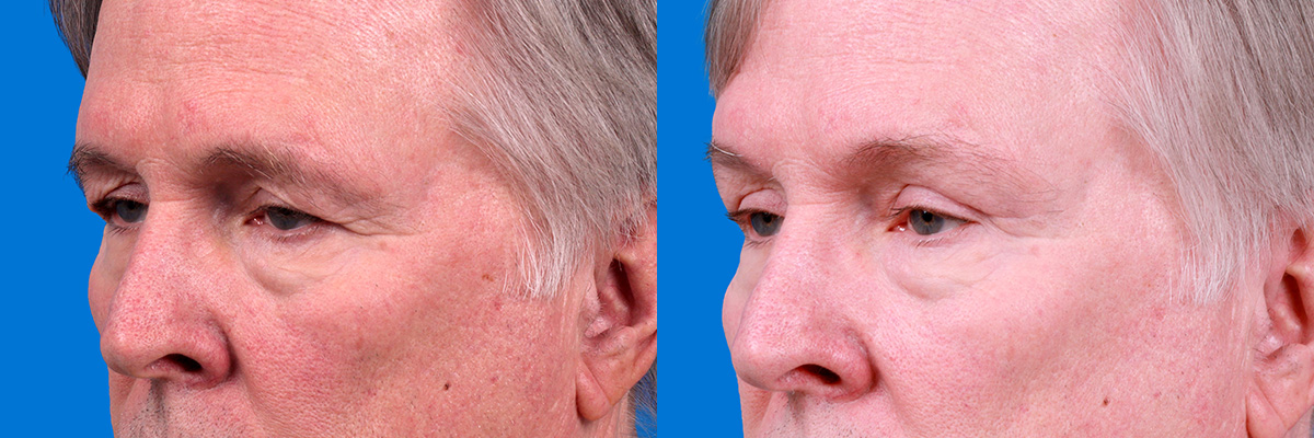 Eyelid Surgery Before & After Gallery - Patient 278662 - Image 4