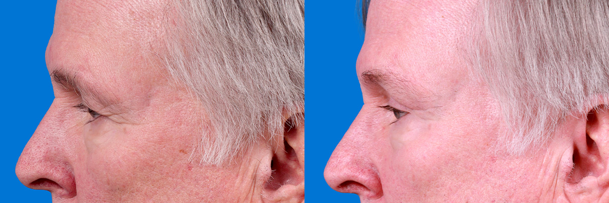 Eyelid Surgery Before & After Gallery - Patient 278662 - Image 5