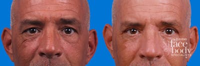 Eyelid Surgery Before & After Gallery - Patient 228907 - Image 1