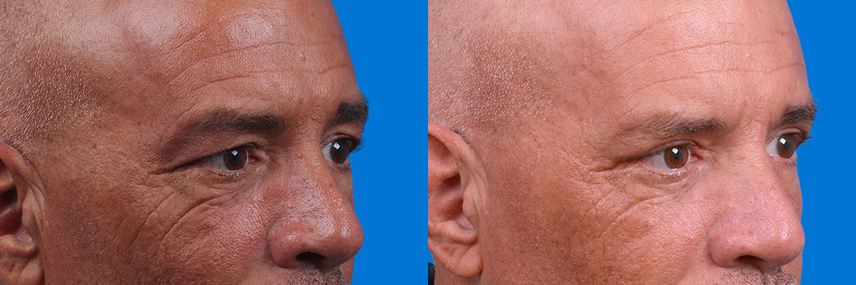 Eyelid Surgery Before & After Gallery - Patient 228907 - Image 2