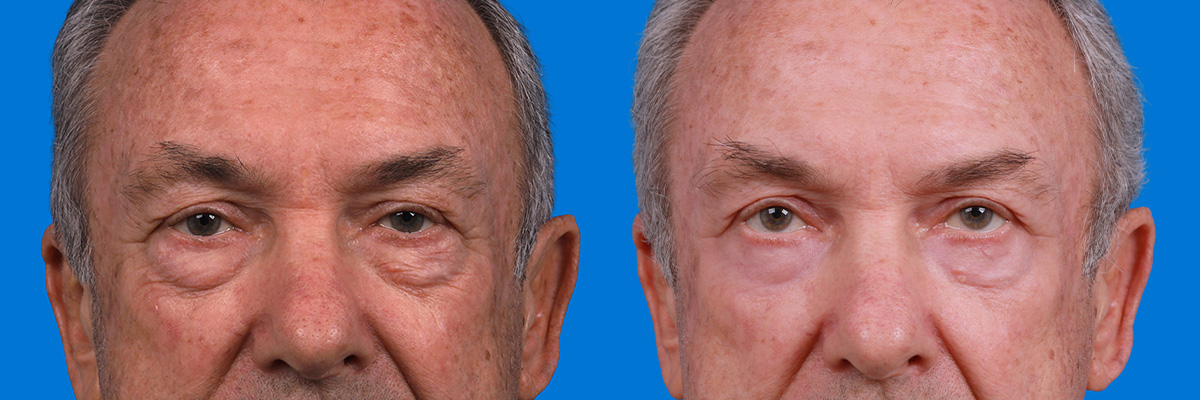 Eyelid Surgery Before & After Gallery - Patient 405021 - Image 1