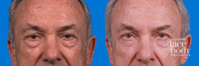 Eyelid Surgery Before & After Gallery - Patient 405021 - Image 1