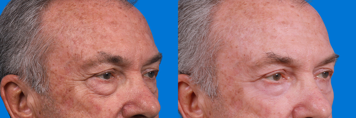 Eyelid Surgery Before & After Gallery - Patient 405021 - Image 2