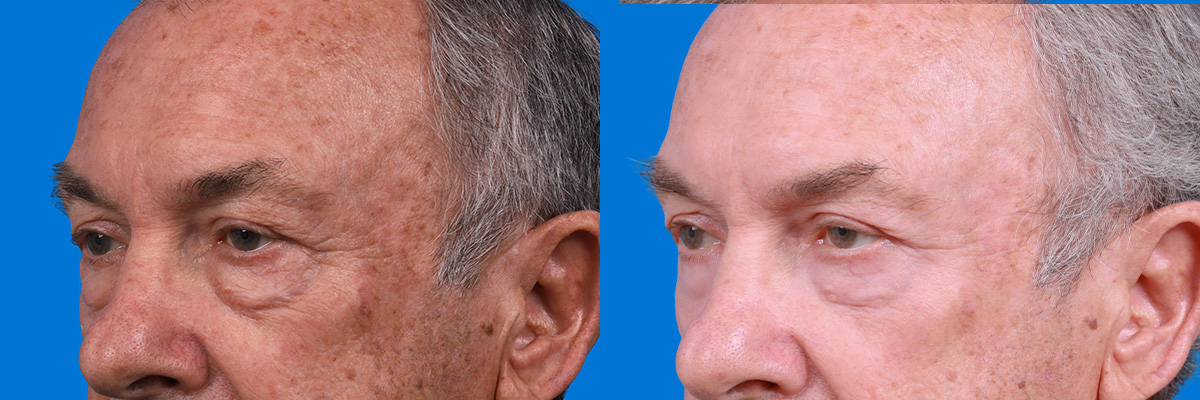 Eyelid Surgery Before & After Gallery - Patient 405021 - Image 3