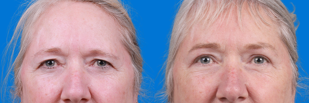 Eyelid Surgery Before & After Gallery - Patient 395179 - Image 1