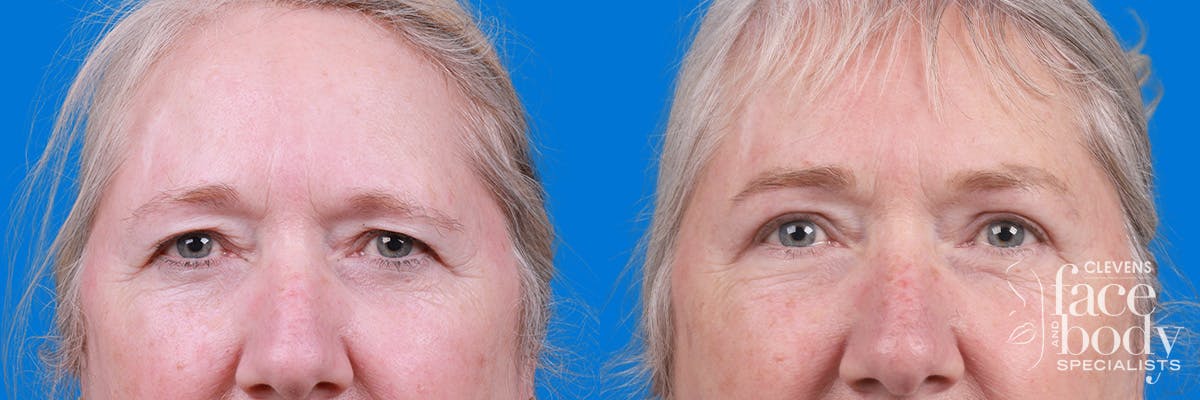 Eyelid Surgery Before & After Gallery - Patient 395179 - Image 1