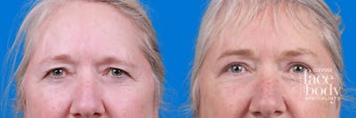 Eyelid Surgery Before & After Gallery - Patient 395179 - Image 1