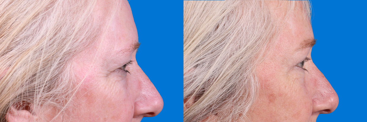 Eyelid Surgery Before & After Gallery - Patient 395179 - Image 3