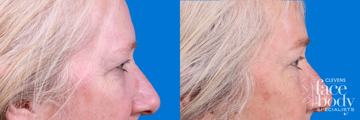 Eyelid Surgery Before & After Gallery - Patient 395179 - Image 3