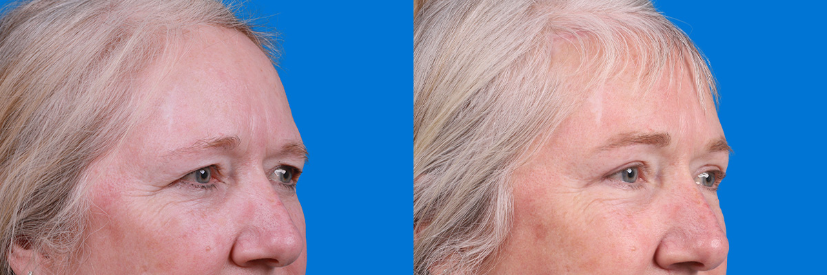 Eyelid Surgery Before & After Gallery - Patient 395179 - Image 2
