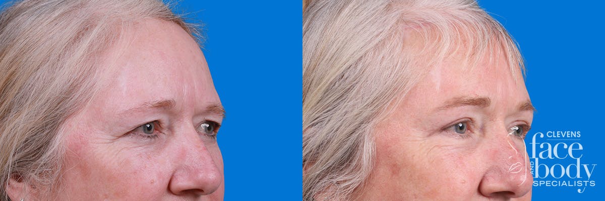 Eyelid Surgery Before & After Gallery - Patient 395179 - Image 2