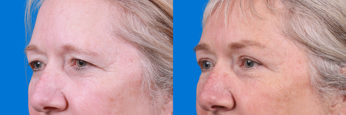 Eyelid Surgery Before & After Gallery - Patient 395179 - Image 4