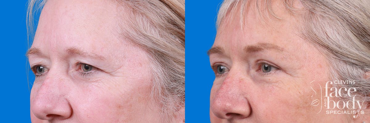 Eyelid Surgery Before & After Gallery - Patient 395179 - Image 4