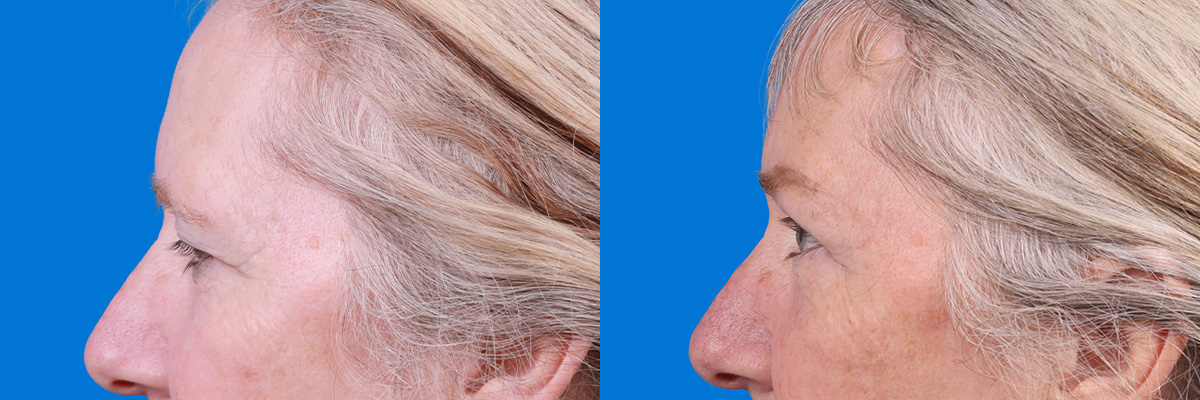 Eyelid Surgery Before & After Gallery - Patient 395179 - Image 5