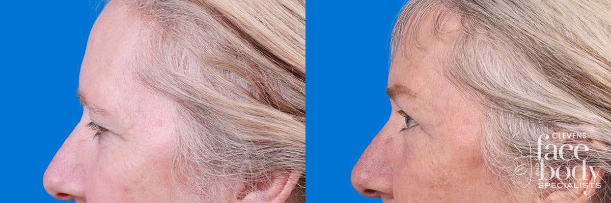 Eyelid Surgery Before & After Gallery - Patient 395179 - Image 5