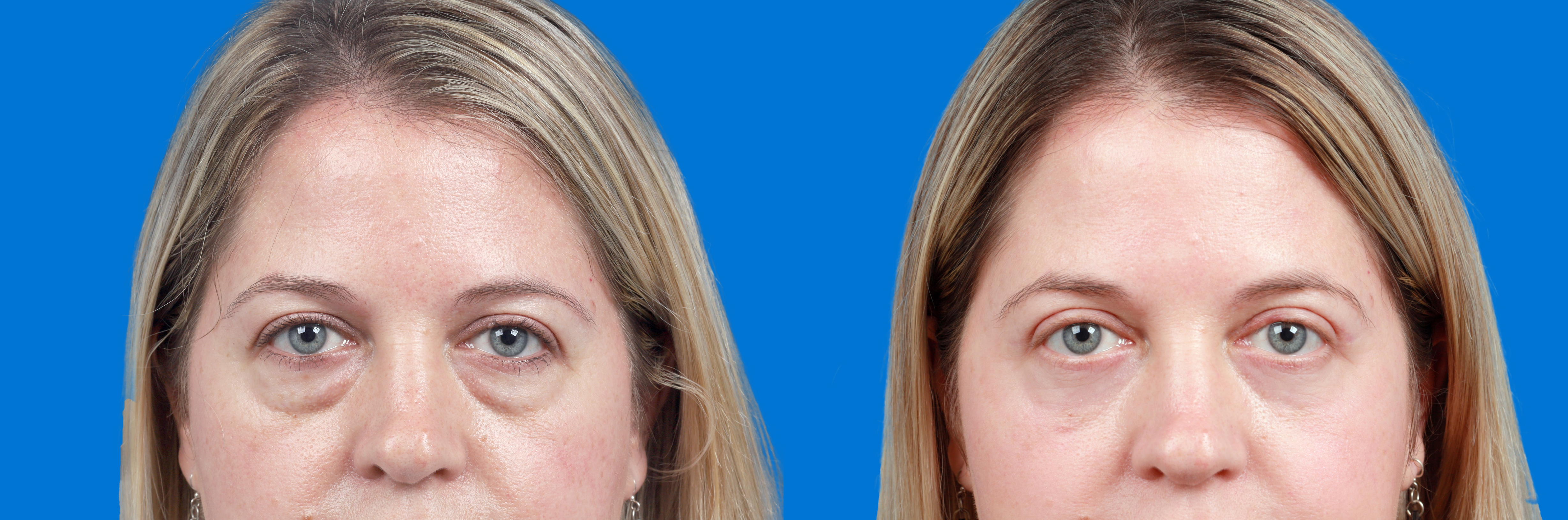 Dermal Fillers Before & After Gallery - Patient 278184 - Image 1