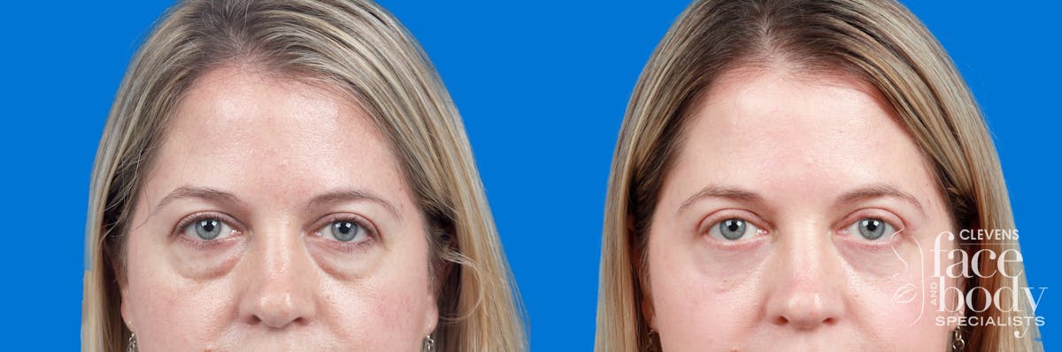 Eyelid Surgery Before & After Gallery - Patient 192912 - Image 1