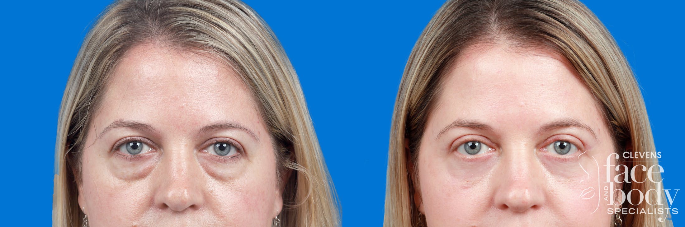 Eyelid Surgery Before & After Gallery - Patient 192912 - Image 1