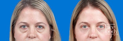 Eyelid Surgery Before & After Gallery - Patient 192912 - Image 1