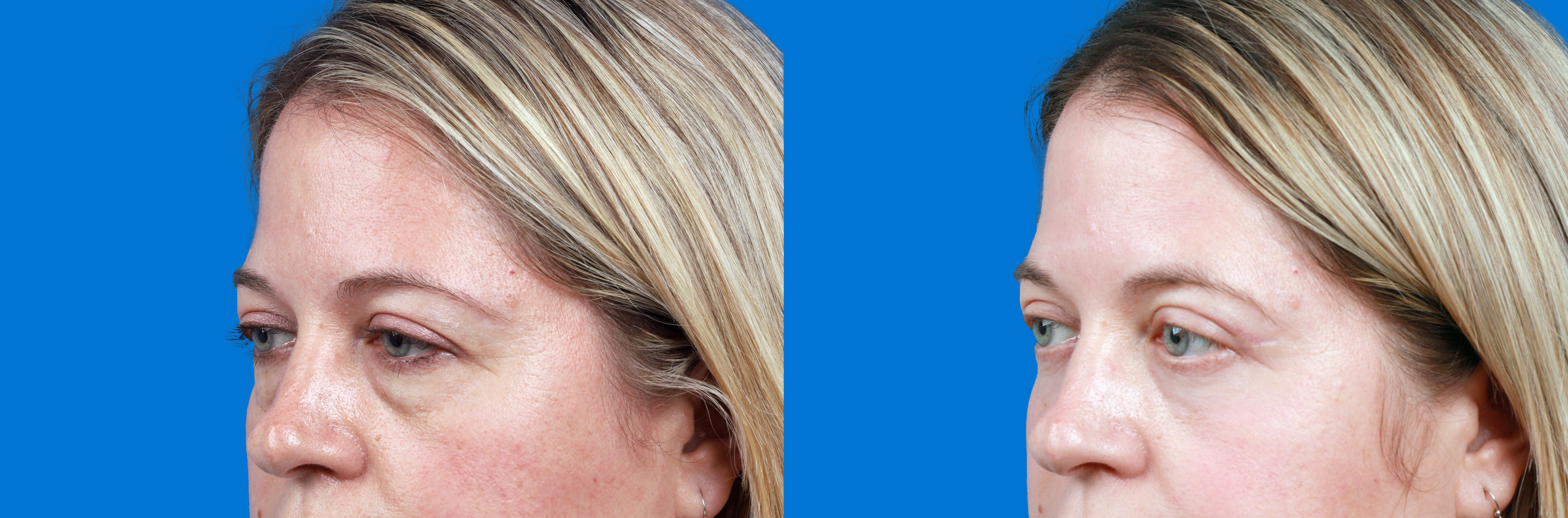 Dermal Fillers Before & After Gallery - Patient 278184 - Image 2