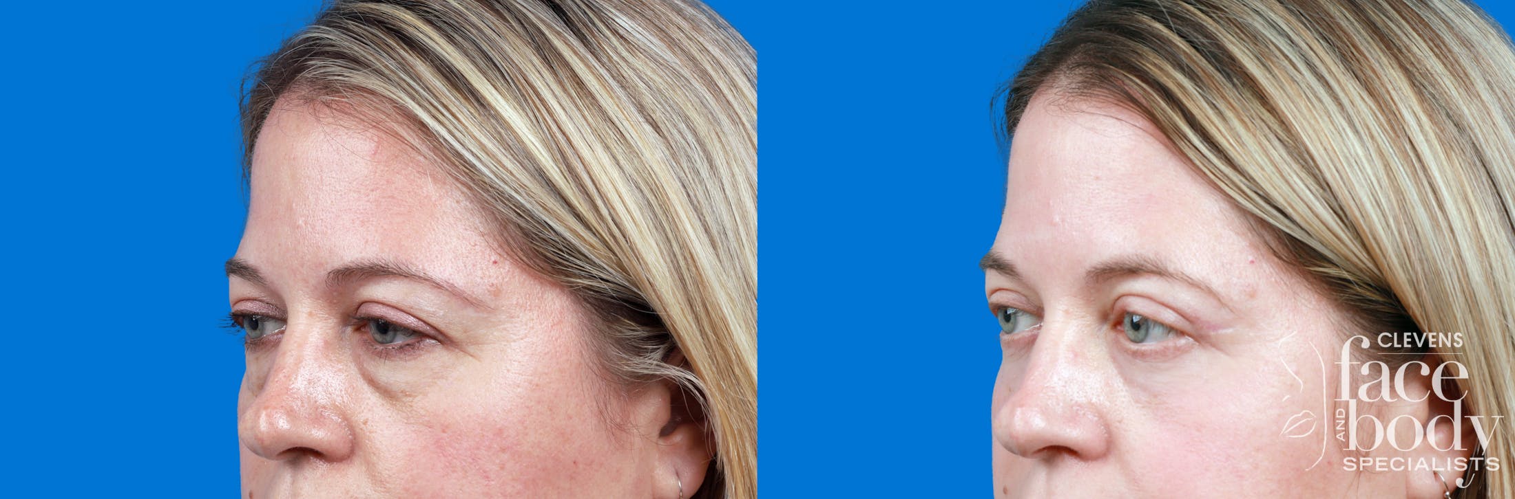 Eyelid Surgery Before & After Gallery - Patient 192912 - Image 2