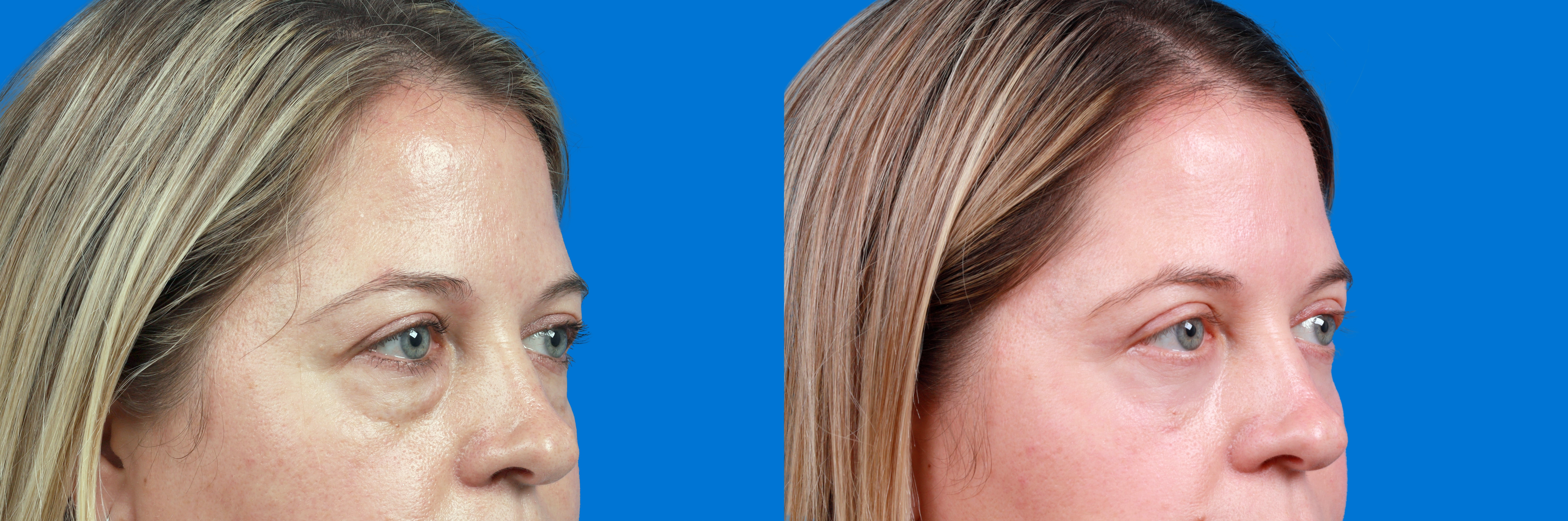 Dermal Fillers Before & After Gallery - Patient 278184 - Image 3