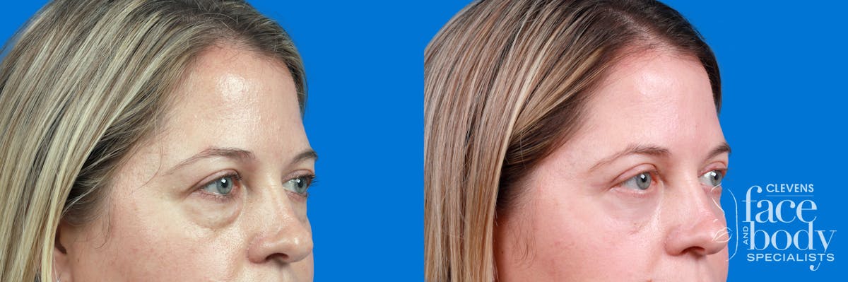 Eyelid Surgery Before & After Gallery - Patient 192912 - Image 3