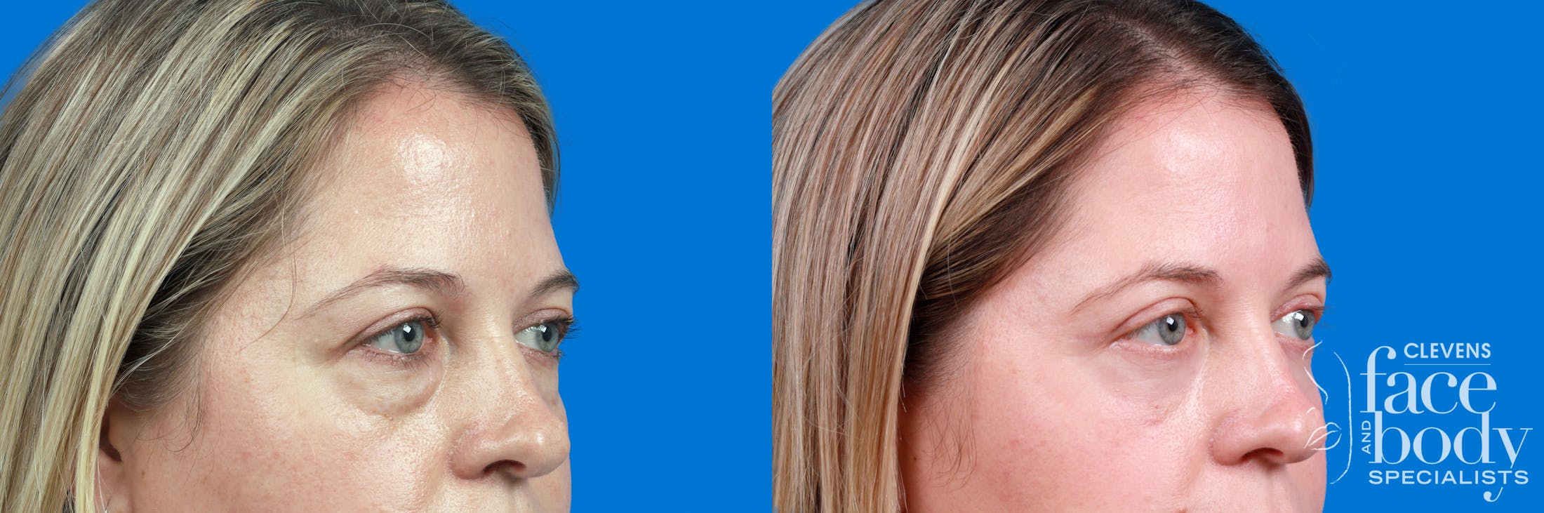 Eyelid Surgery Before & After Gallery - Patient 192912 - Image 3