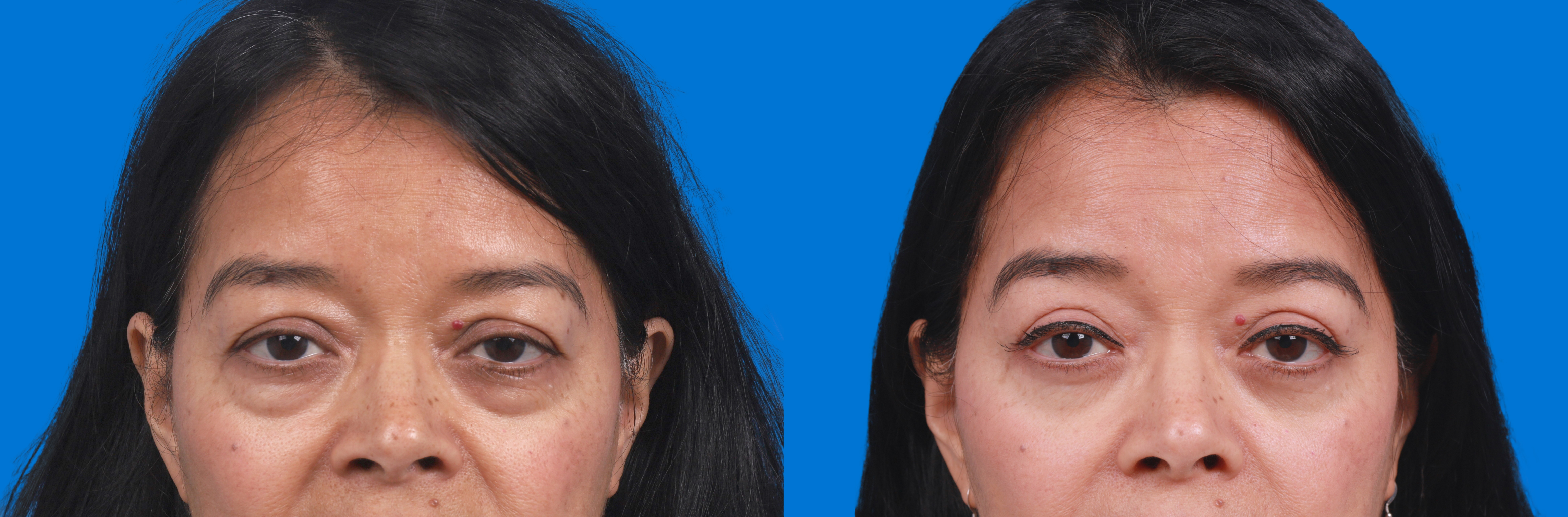Eyelid Surgery Before & After Gallery - Patient 329725 - Image 1