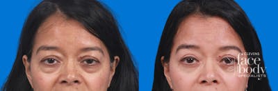 Eyelid Surgery Before & After Gallery - Patient 329725 - Image 1