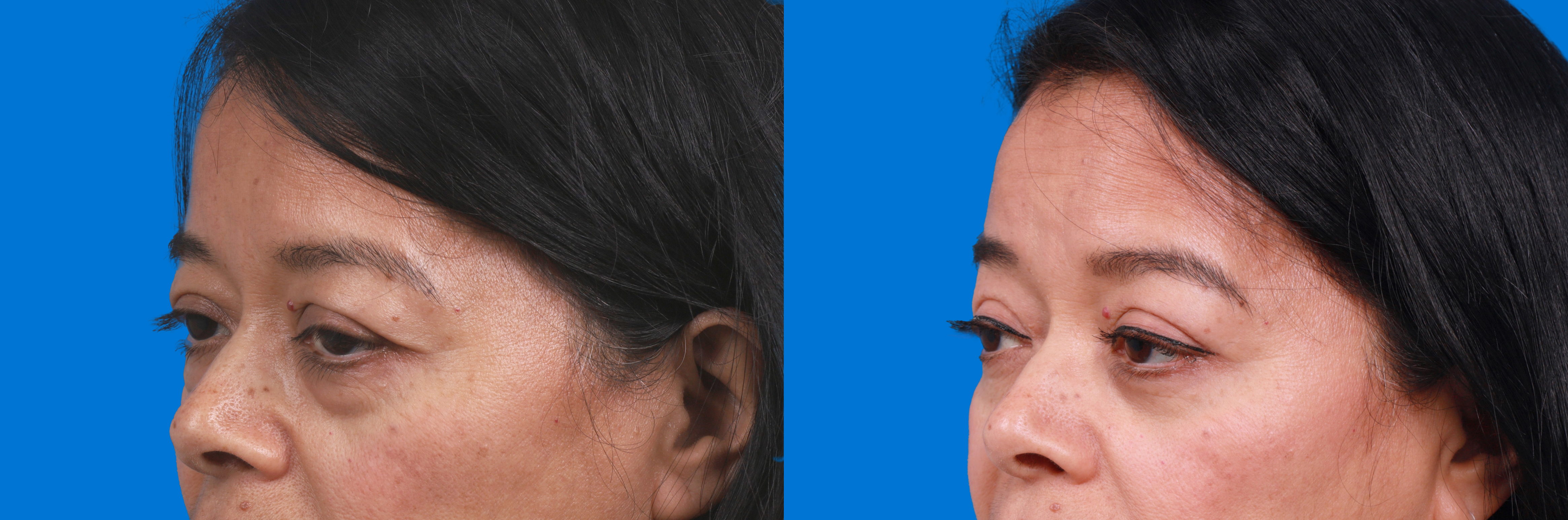 Eyelid Surgery Before & After Gallery - Patient 329725 - Image 3