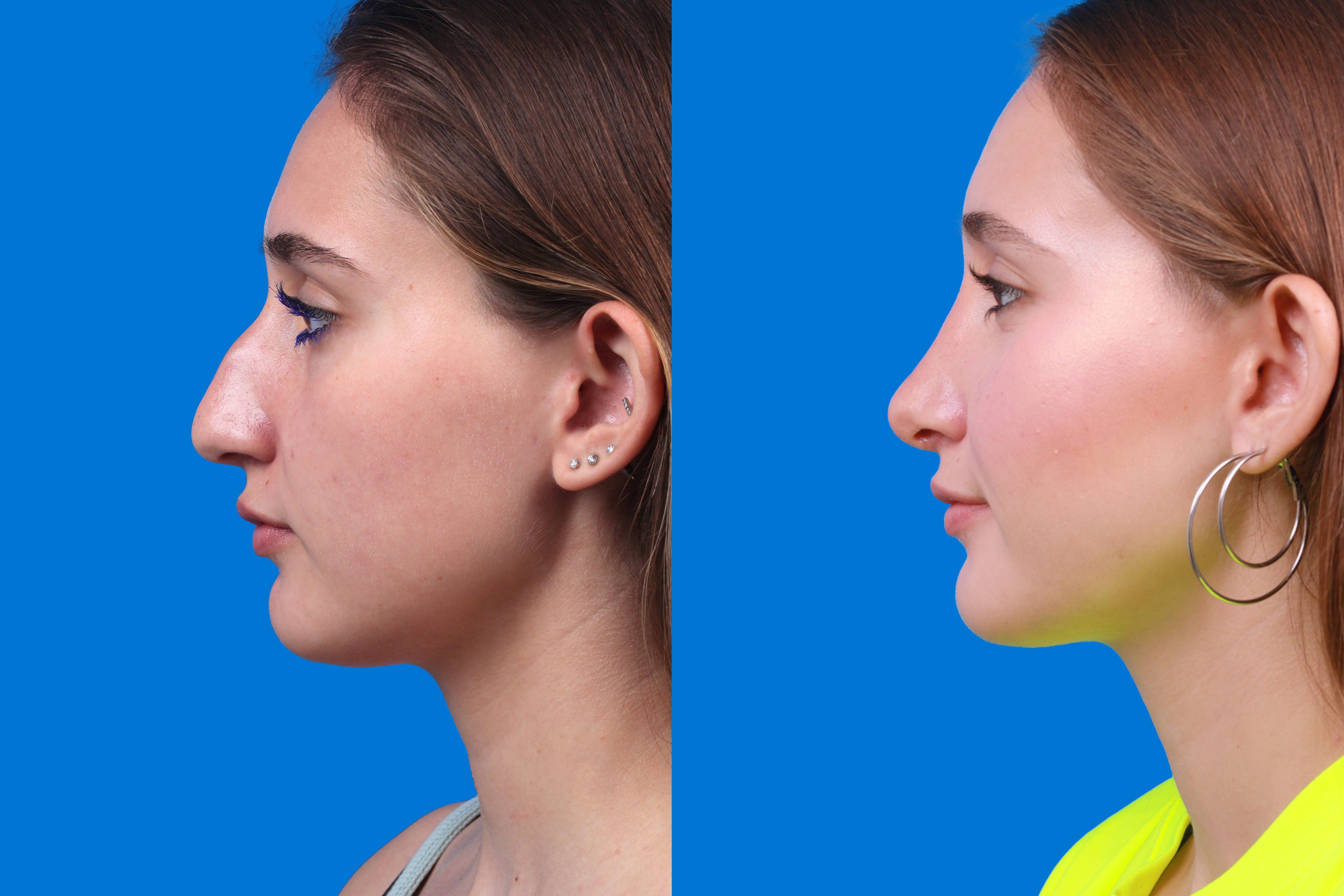 Rhinoplasty Before & After Gallery - Patient 387207 - Image 5