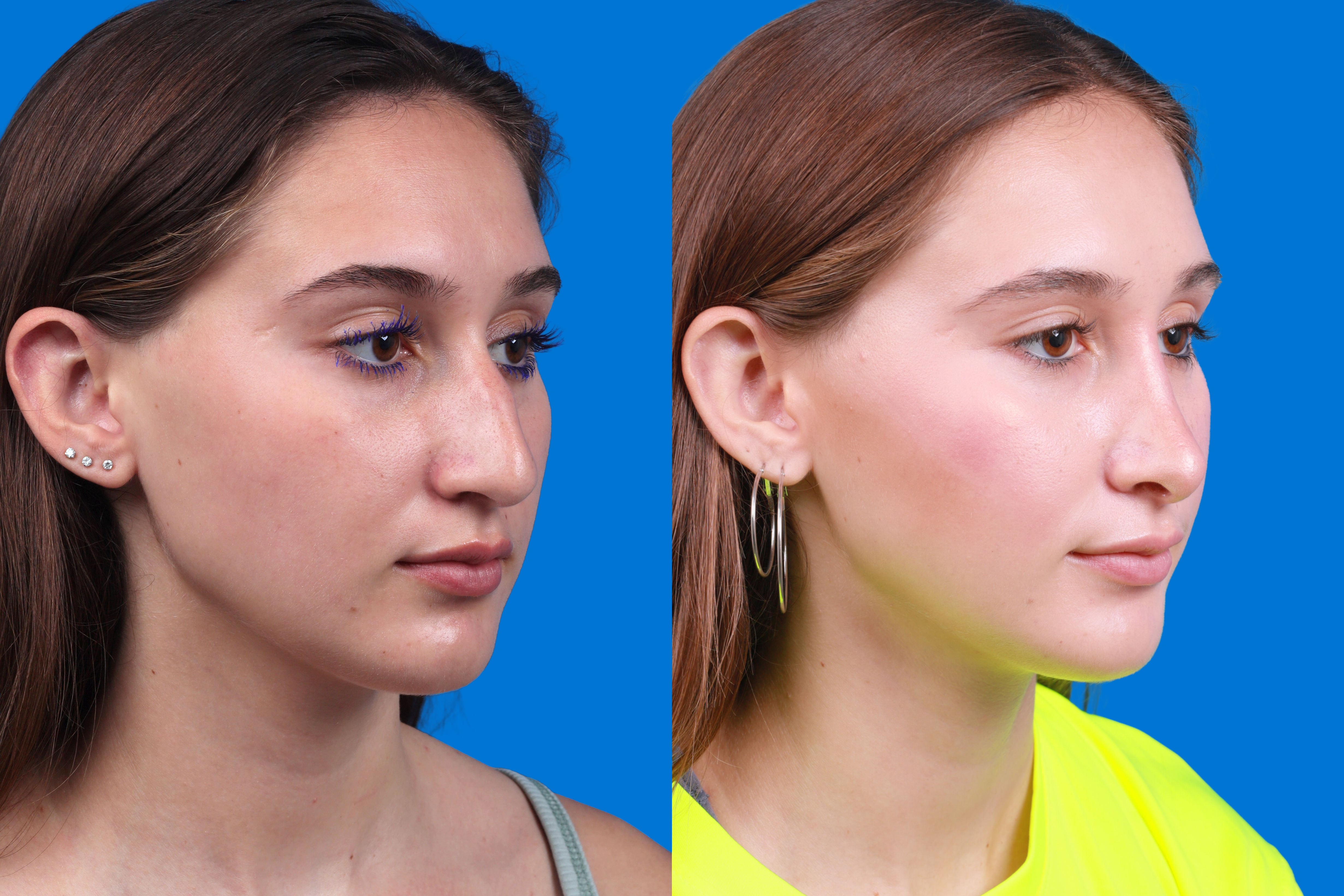 Rhinoplasty Before & After Gallery - Patient 387207 - Image 2