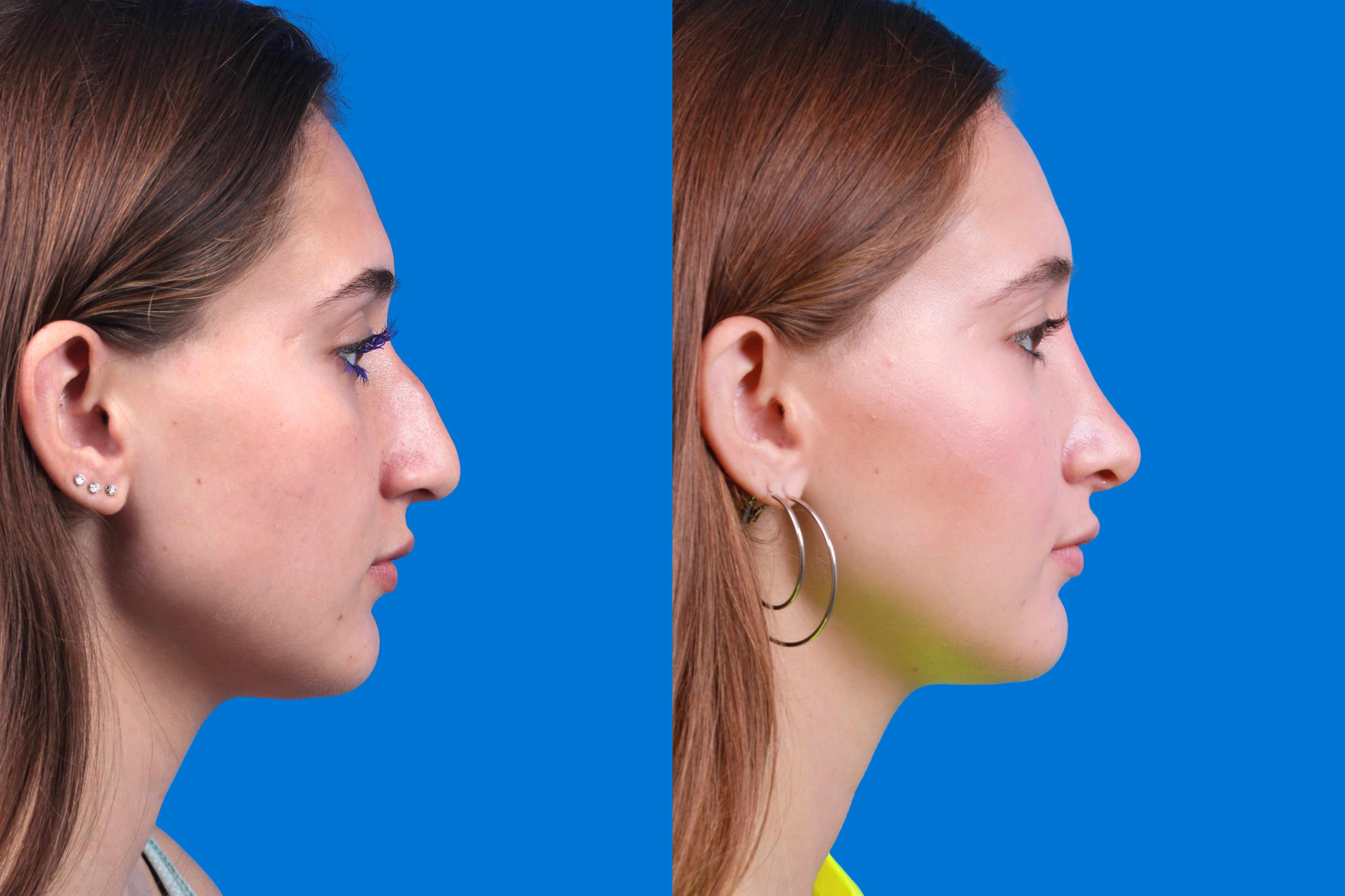 Rhinoplasty Before & After Gallery - Patient 387207 - Image 3