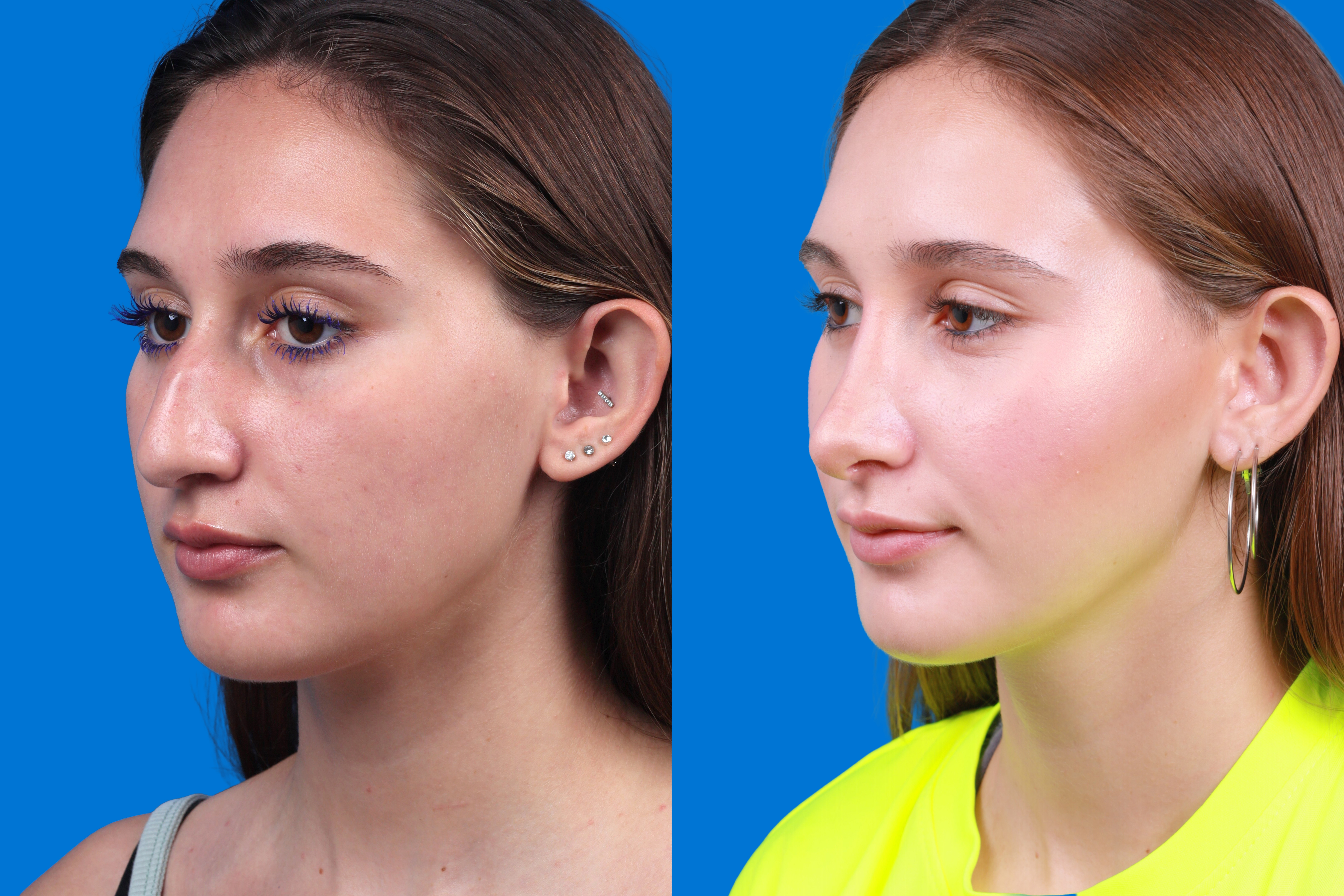 Rhinoplasty Before & After Gallery - Patient 387207 - Image 4