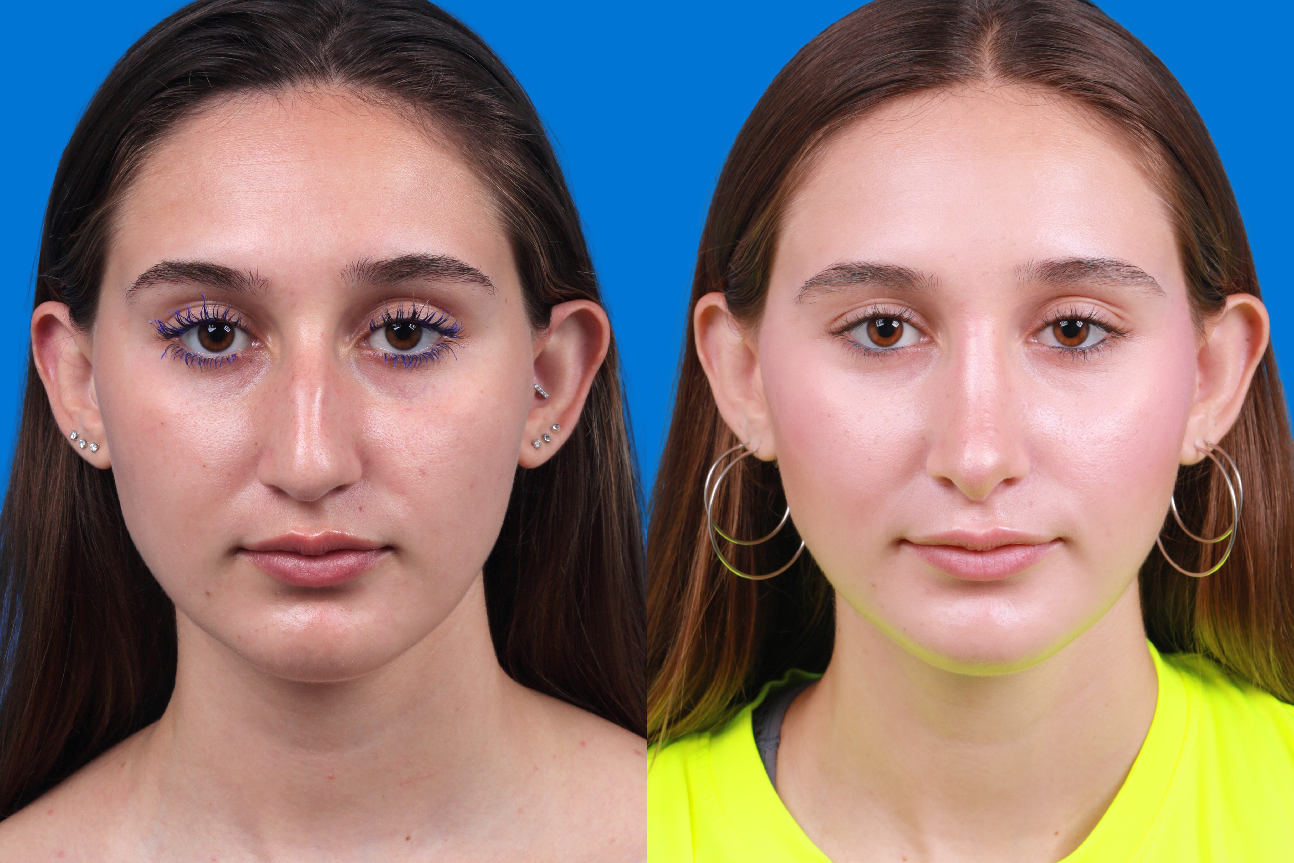 Rhinoplasty Before & After Gallery - Patient 387207 - Image 1