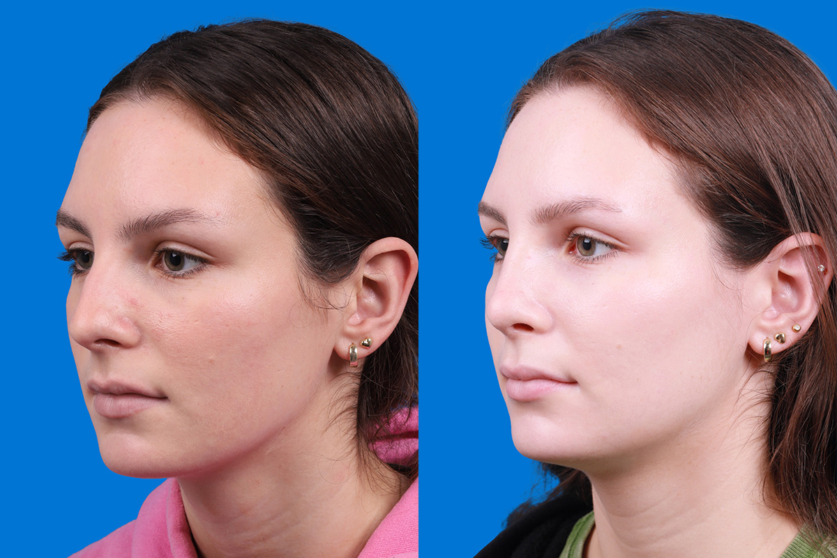 Rhinoplasty Before & After Gallery - Patient 405628 - Image 4