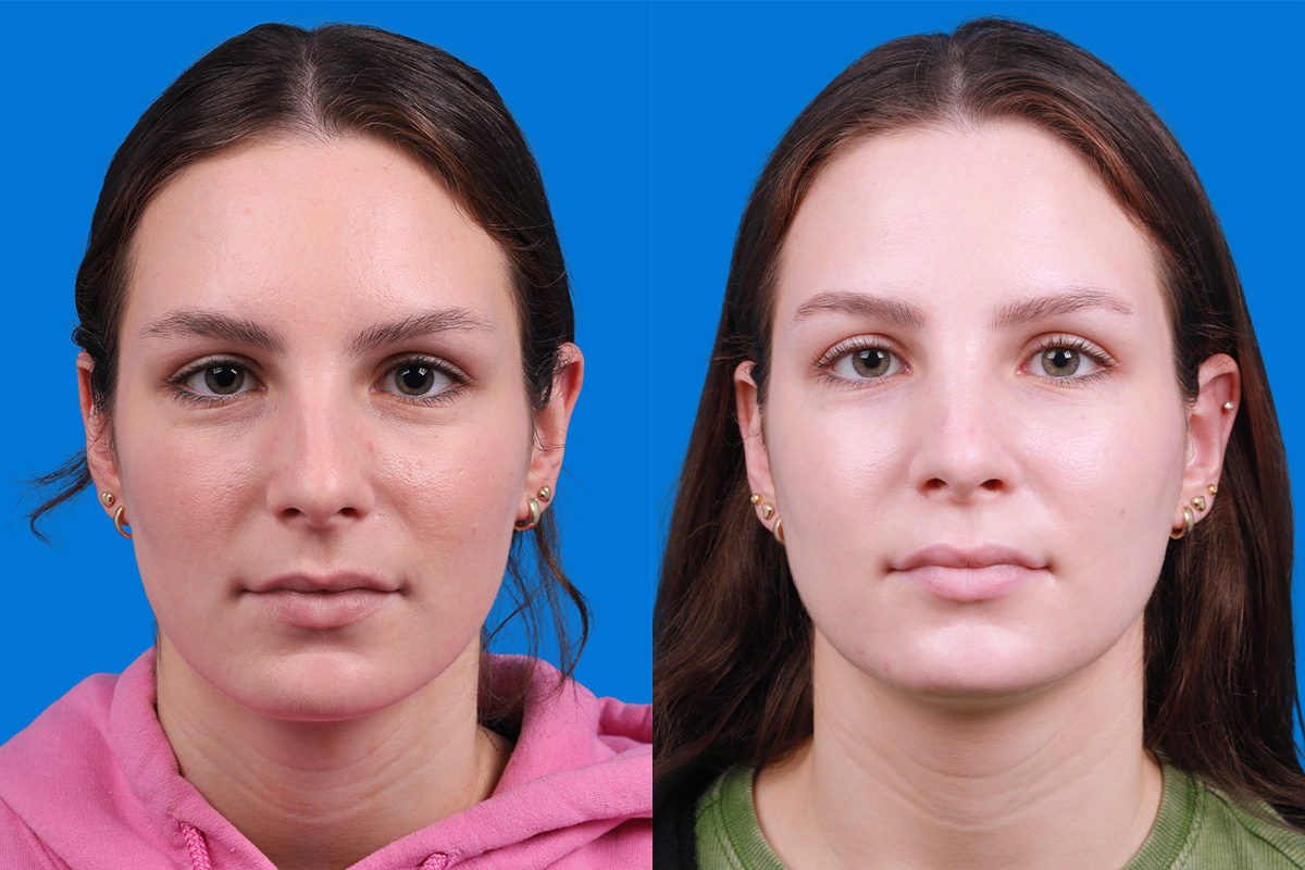 Rhinoplasty Before & After Gallery - Patient 405628 - Image 1
