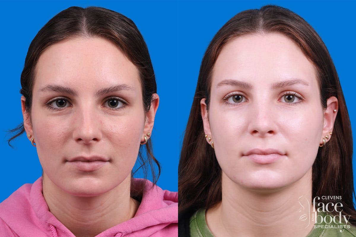 Rhinoplasty Before & After Gallery - Patient 405628 - Image 1