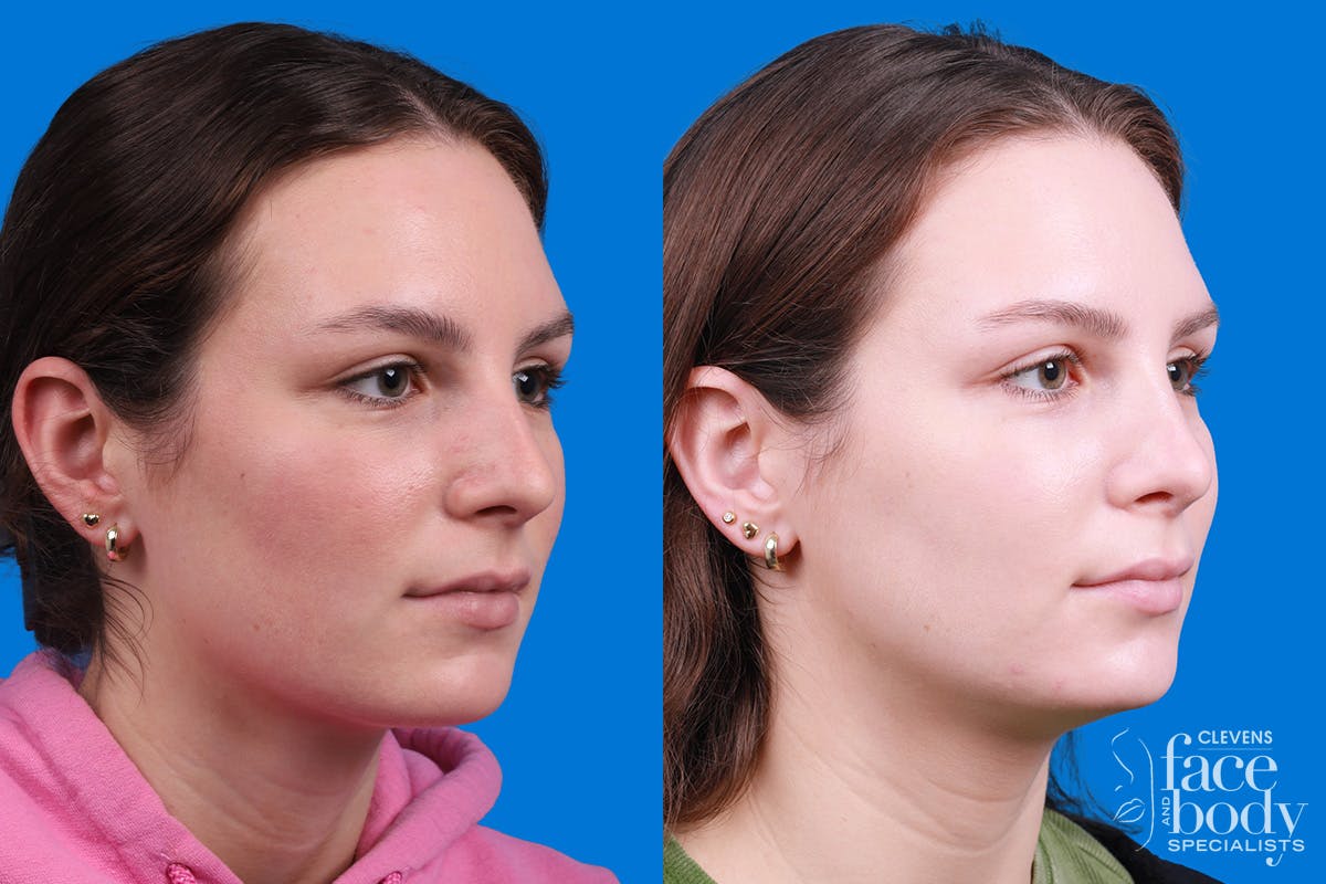 Rhinoplasty Before & After Gallery - Patient 405628 - Image 2