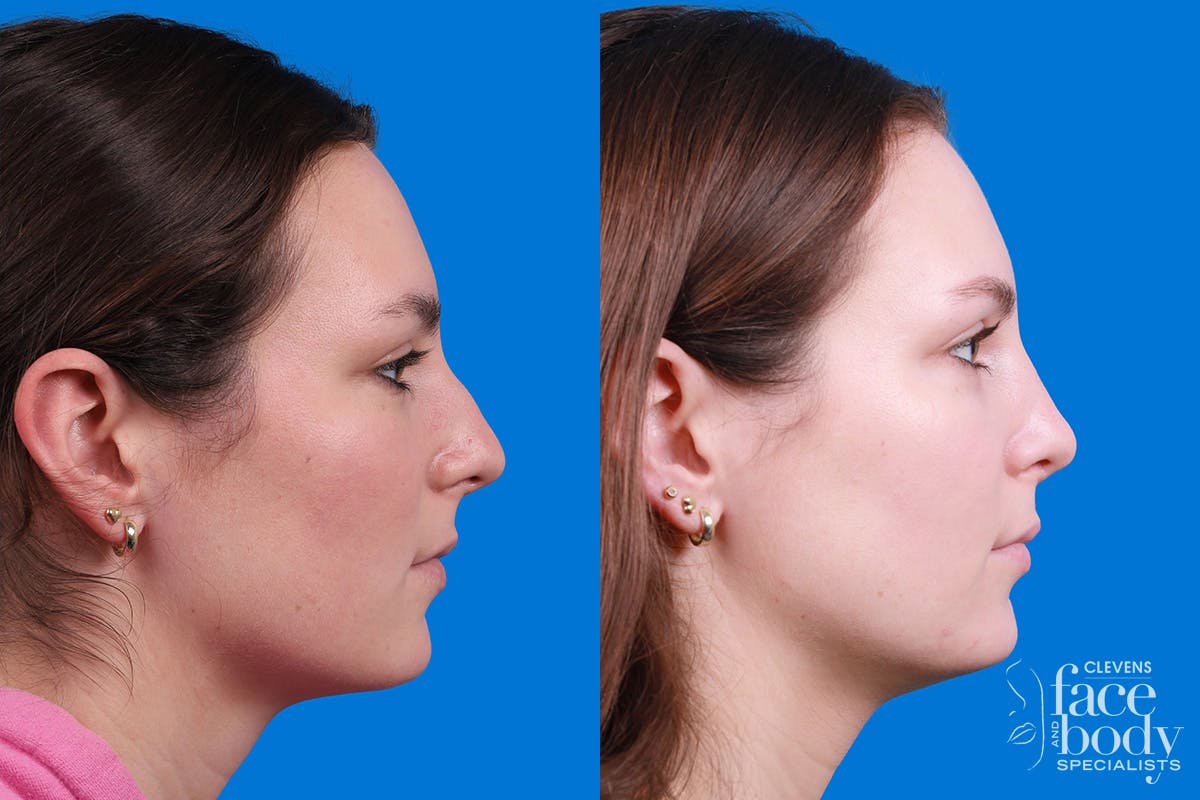 Rhinoplasty Before & After Gallery - Patient 405628 - Image 3