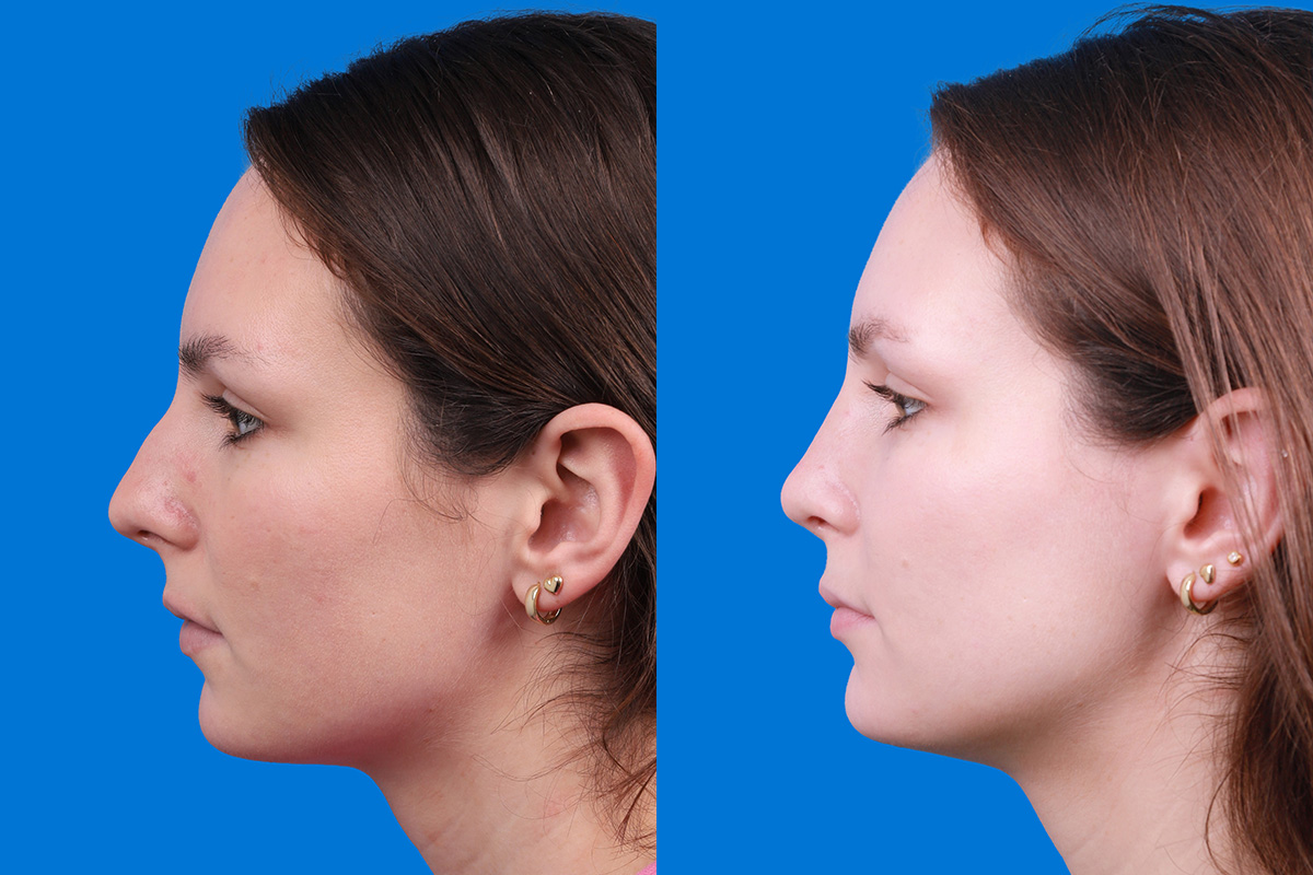 Rhinoplasty Before & After Gallery - Patient 405628 - Image 5