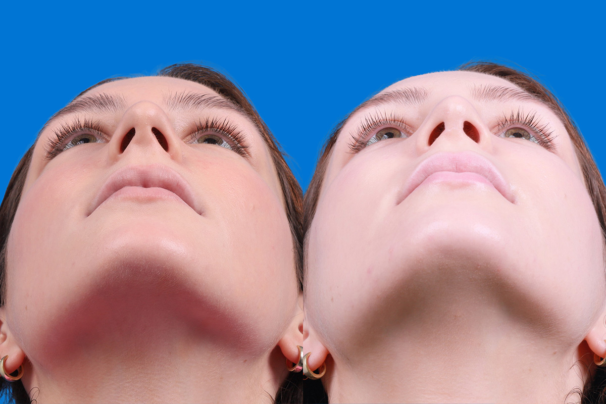 Rhinoplasty Before & After Gallery - Patient 405628 - Image 6